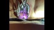 ดูหนังav Manipulation of cervix with sound tenaculum Mp4 ฟรี