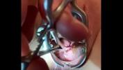 หนังxxx Sound tenaculum applying traction to cervix ร้อน 2024