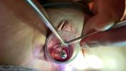 ดูหนังav Dilating to 9mm w Tenaculum and Hegar Mp4 ฟรี